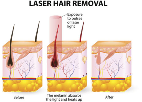 Laser hair removal diagram