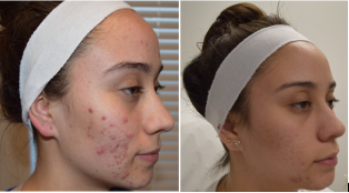 Acne before and after treatment