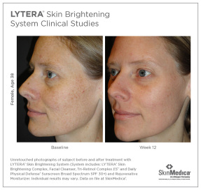 Skin Brightening results